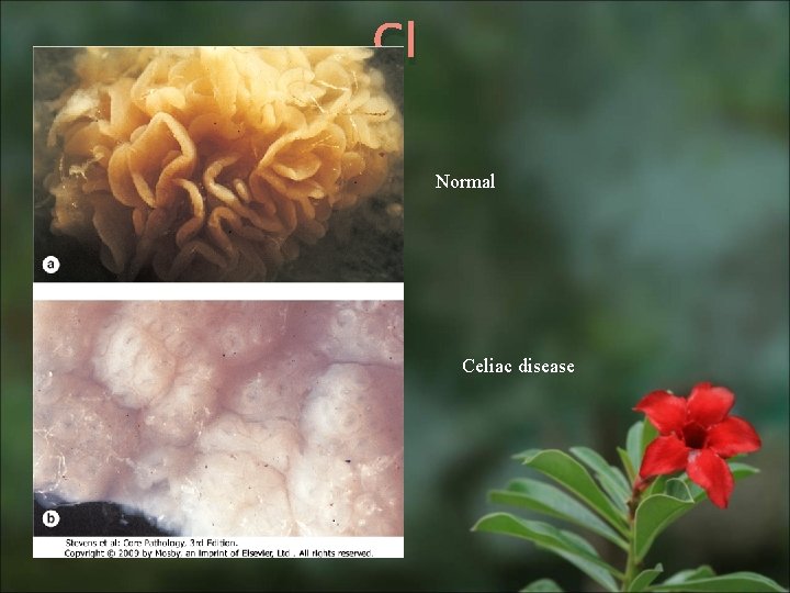 Cl Normal Celiac disease 