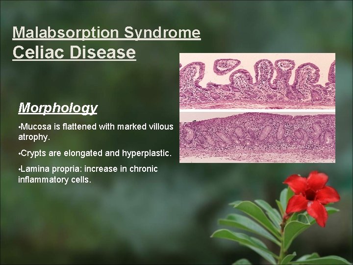 Malabsorption Syndrome Celiac Disease Morphology • Mucosa is flattened with marked villous atrophy. •