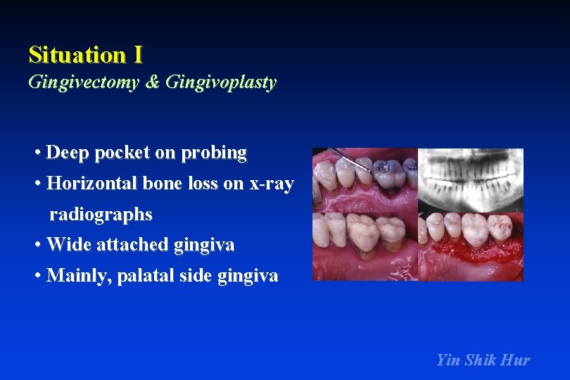 Situation I Gingivectomy & Gingivoplasty • Deep pocket on probing • Horizontal bone loss