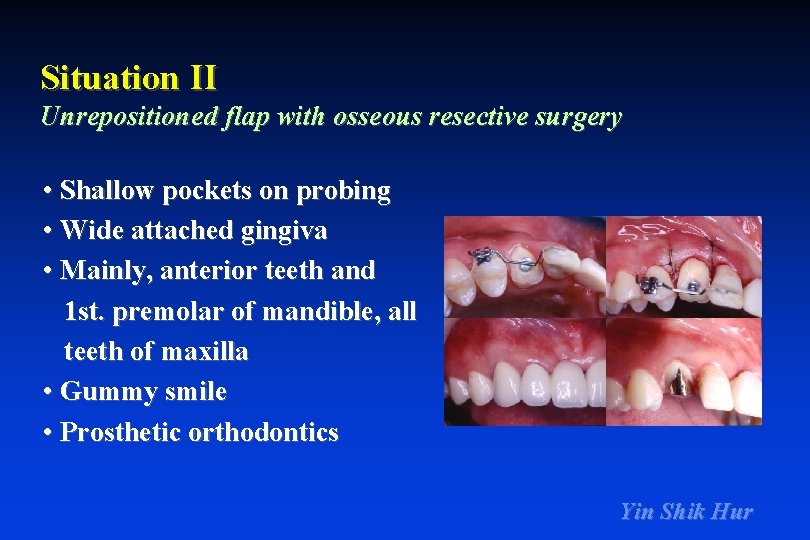 Situation II Unrepositioned flap with osseous resective surgery • Shallow pockets on probing •