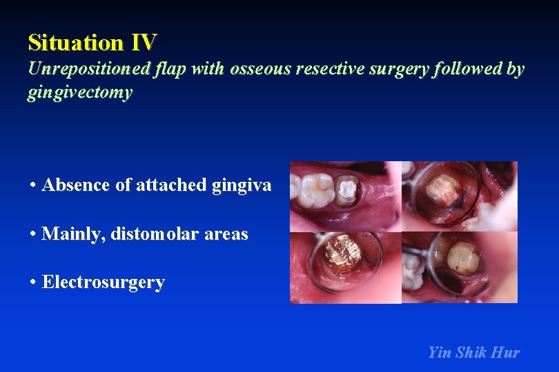 Situation IV Unrepositioned flap with osseous resective surgery followed by gingivectomy • Absence of
