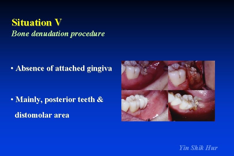 Situation V Bone denudation procedure • Absence of attached gingiva • Mainly, posterior teeth