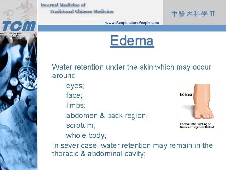 Edema Water retention under the skin which may occur around eyes; face; limbs; abdomen
