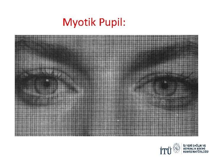 Myotik Pupil: Myotik Pupil: