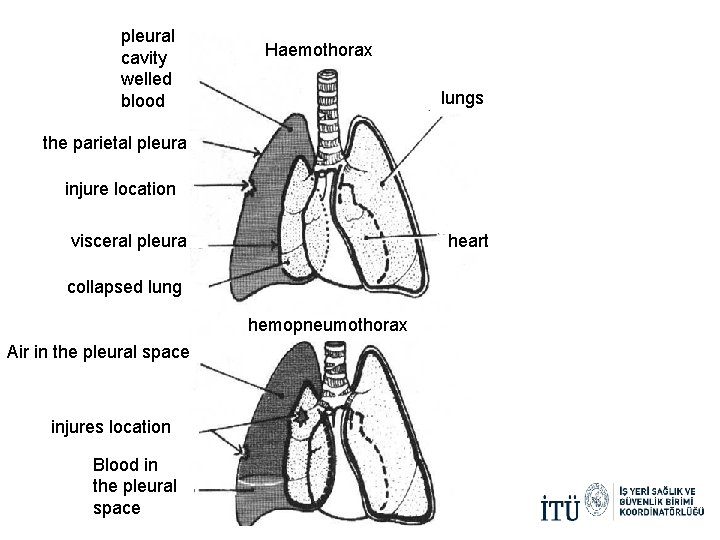 pleural cavity welled blood Haemothorax lungs the parietal pleura injure location heart visceral pleura pleural cavity welled blood Haemothorax lungs the parietal pleura injure location heart visceral pleura
