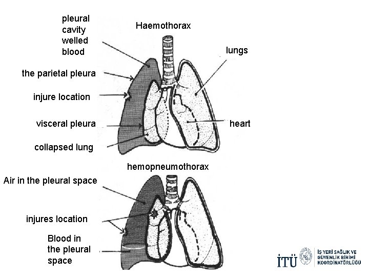 pleural cavity welled blood Haemothorax lungs the parietal pleura injure location heart visceral pleura