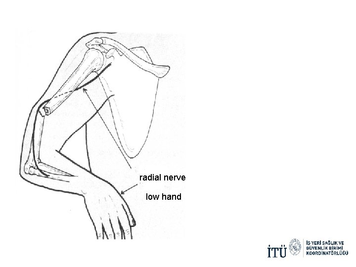 radial nerve low hand 