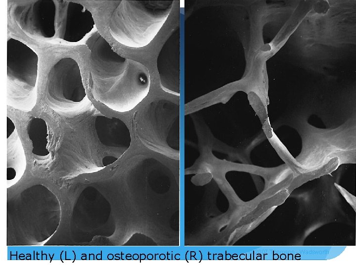 © 2007 Thomson - Wadsworth Healthy (L) and osteoporotic (R) trabecular bone 