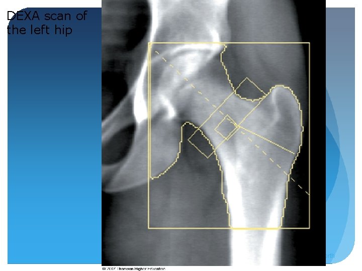 DEXA scan of the left hip © 2007 Thomson - Wadsworth 