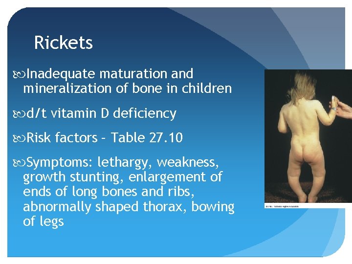 Rickets Inadequate maturation and mineralization of bone in children d/t vitamin D deficiency Risk