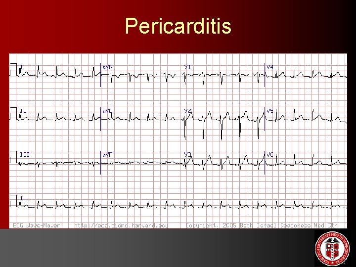 Pericarditis 