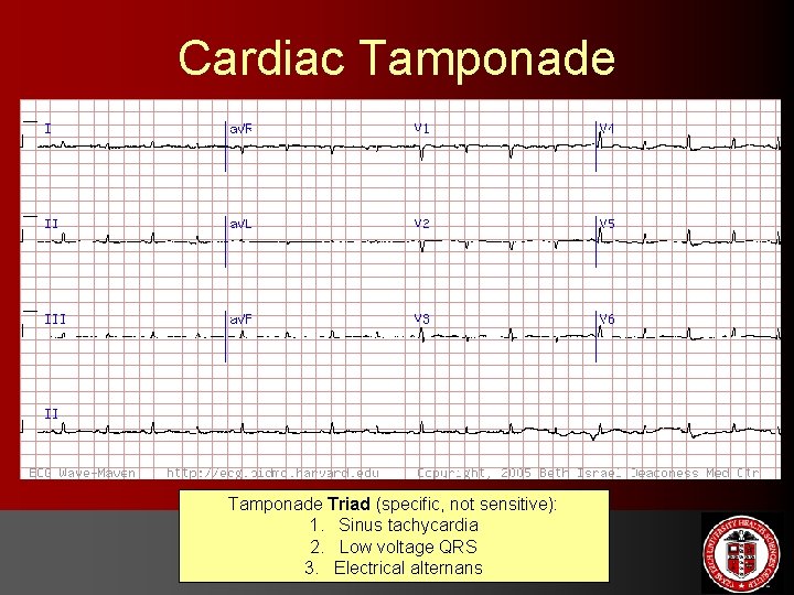 Cardiac Tamponade Triad (specific, not sensitive): 1. Sinus tachycardia 2. Low voltage QRS 3.