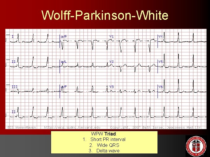 Wolff-Parkinson-White WPW Triad: 1. Short PR interval 2. Wide QRS 3. Delta wave 