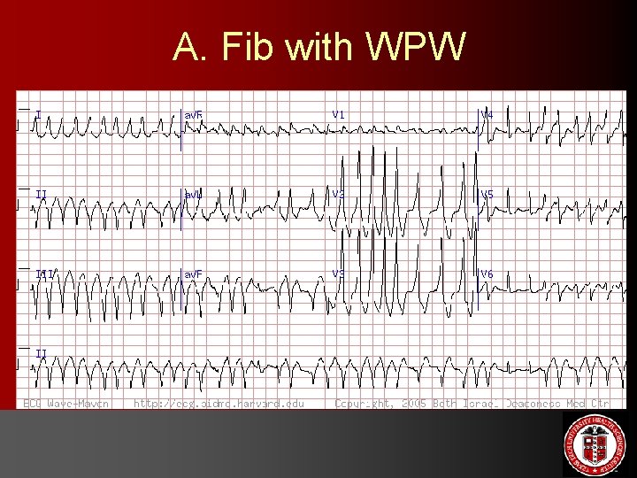 A. Fib with WPW 
