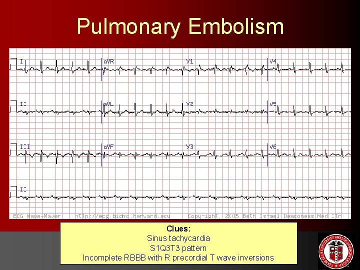 Pulmonary Embolism Clues: Sinus tachycardia S 1 Q 3 T 3 pattern Incomplete RBBB