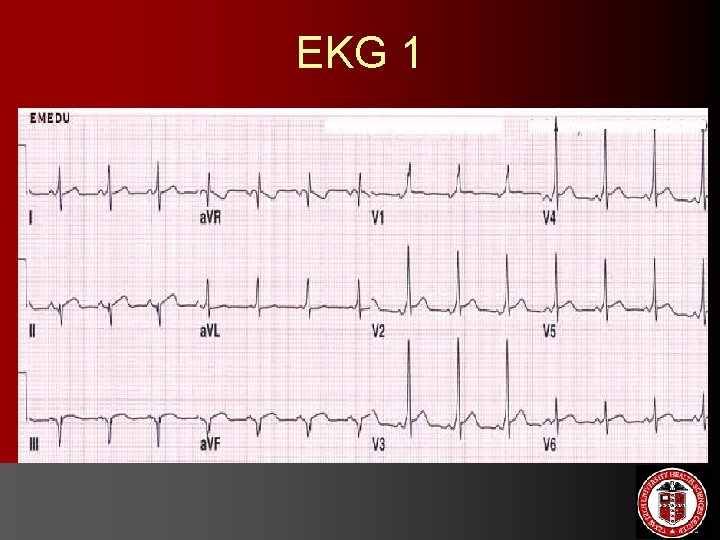 EKG 1 