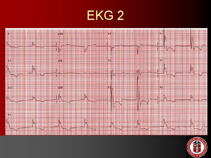EKG 2 