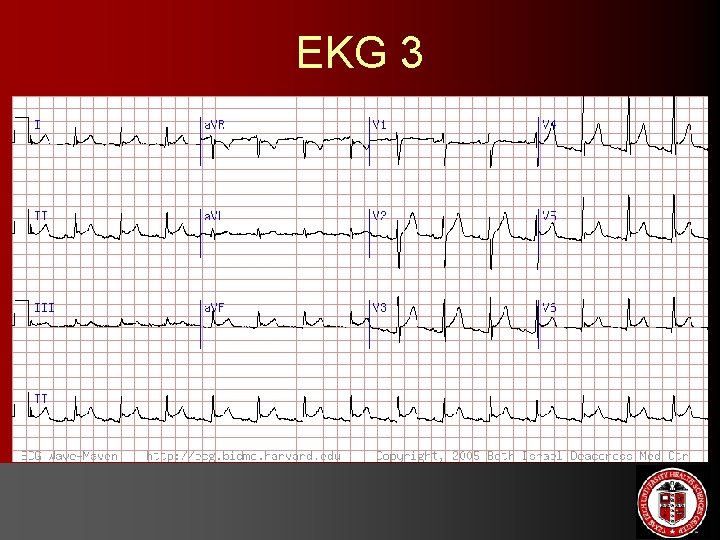EKG 3 