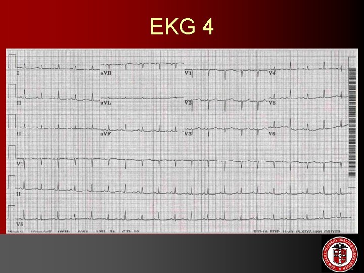 EKG 4 