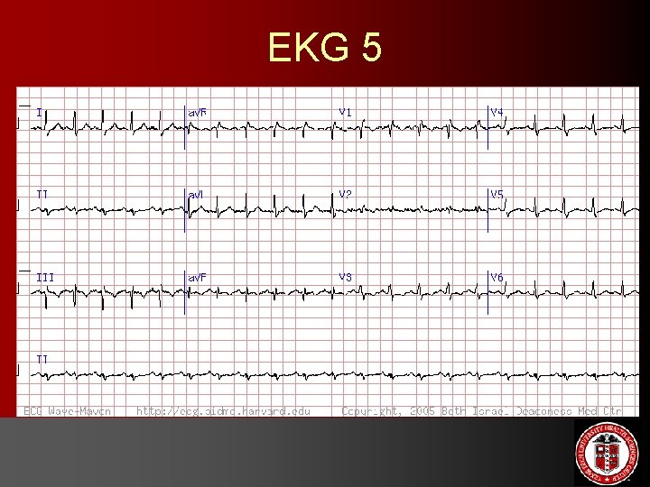 EKG 5 