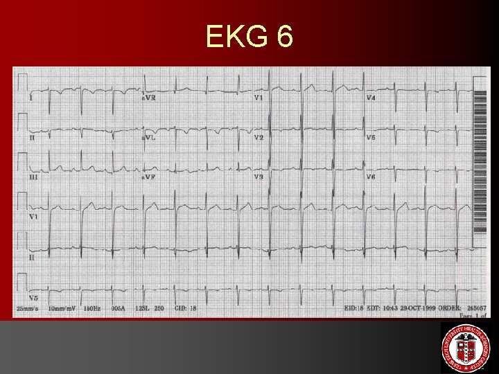 EKG 6 