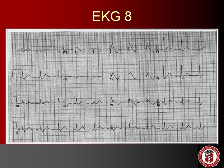 EKG 8 