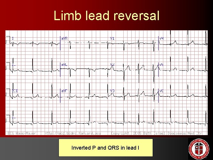Limb lead reversal Inverted P and QRS in lead I 