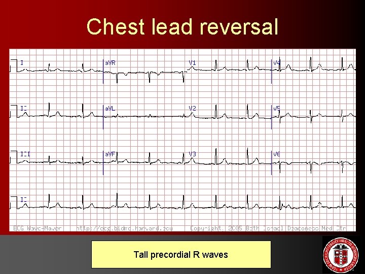 Chest lead reversal Tall precordial R waves 