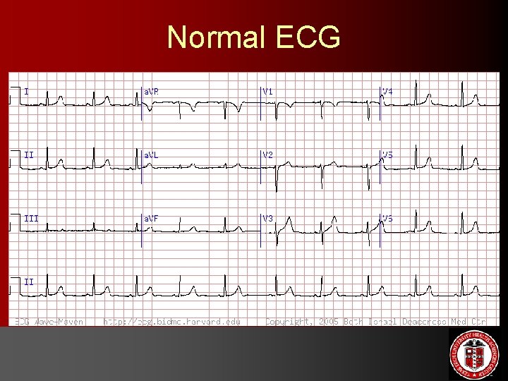 Normal ECG 