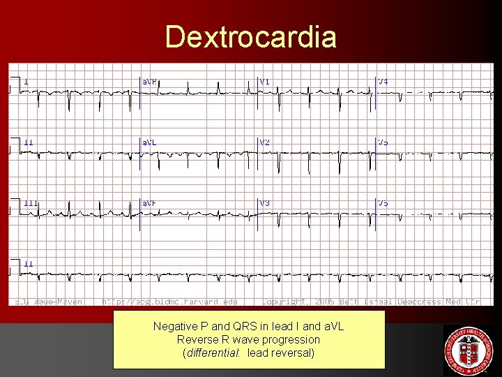 Dextrocardia Negative P and QRS in lead I and a. VL Reverse R wave