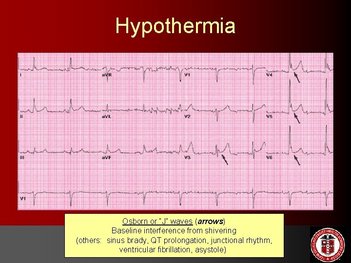 Hypothermia Osborn or “J” waves (arrows) Baseline interference from shivering (others: sinus brady, QT