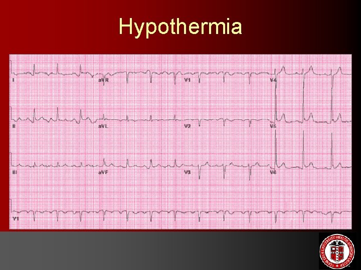 Hypothermia 