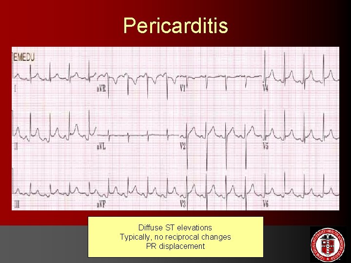 Pericarditis Diffuse ST elevations Typically, no reciprocal changes PR displacement 