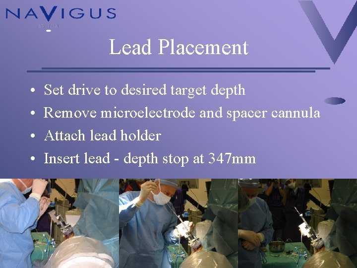 Lead Placement • • Set drive to desired target depth Remove microelectrode and spacer
