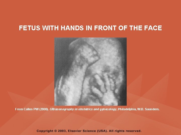 FETUS WITH HANDS IN FRONT OF THE FACE From Callen PW (2000). Ultrasonography in