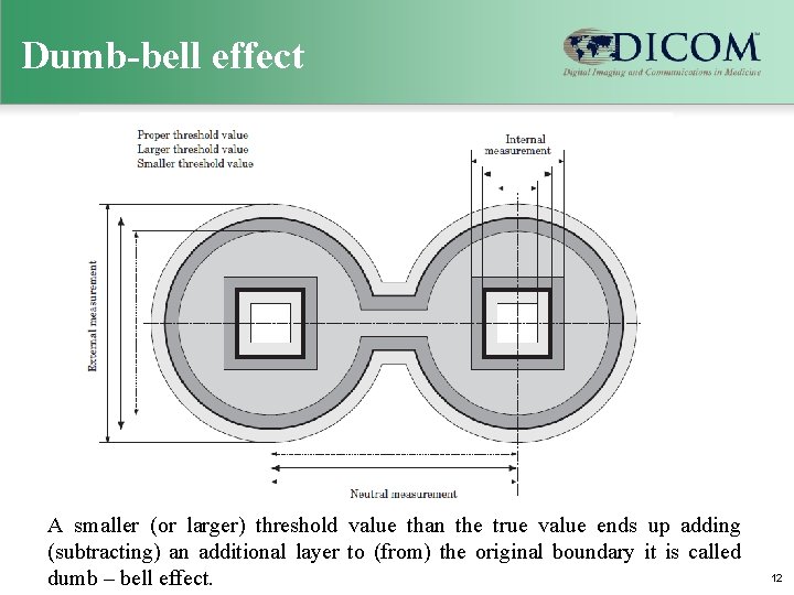 Dumb-bell effect A smaller (or larger) threshold value than the true value ends up