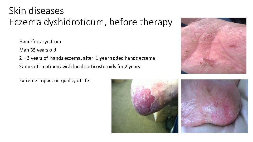 Skin diseases Eczema dyshidroticum, before therapy Hand-foot syndrom Man 35 years old 2 –