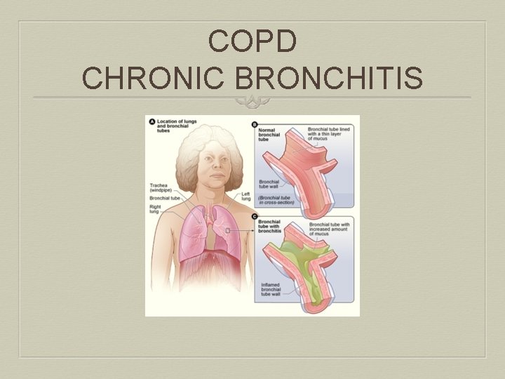 COPD CHRONIC BRONCHITIS 