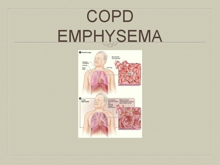 COPD EMPHYSEMA 