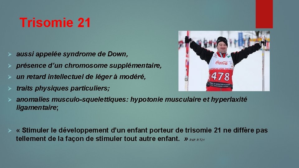Trisomie 21 Ø aussi appelée syndrome de Down, Ø présence d’un chromosome supplémentaire, Ø