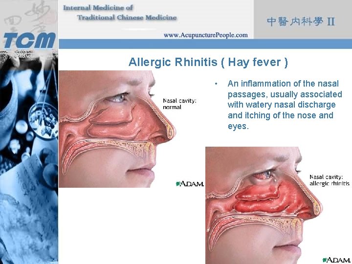 Allergic Rhinitis ( Hay fever ) • An inflammation of the nasal passages, usually