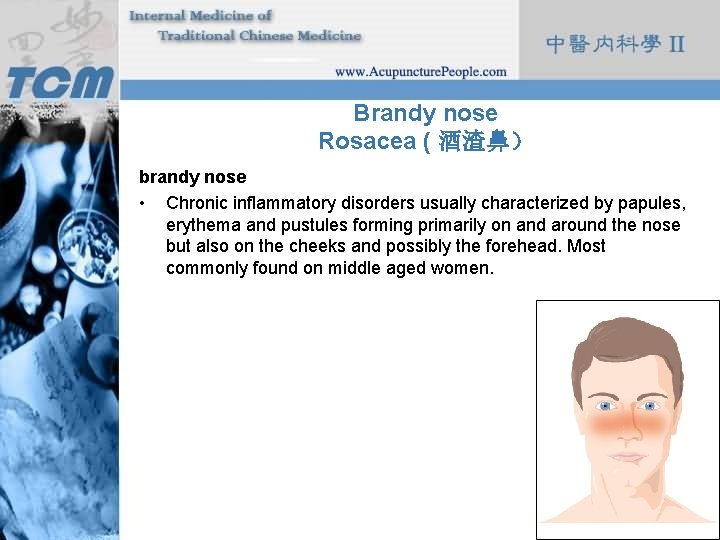 Brandy nose Rosacea ( 酒渣鼻） brandy nose • Chronic inflammatory disorders usually characterized by