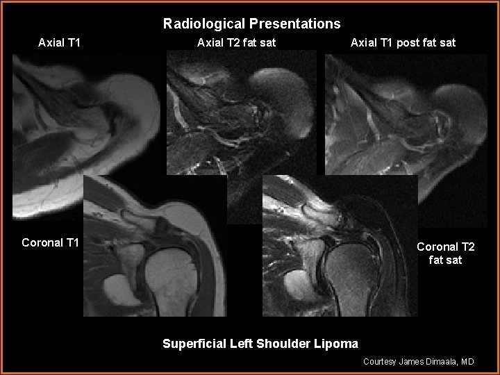 Radiological Presentations Axial T 1 Axial T 2 fat sat Axial T 1 post