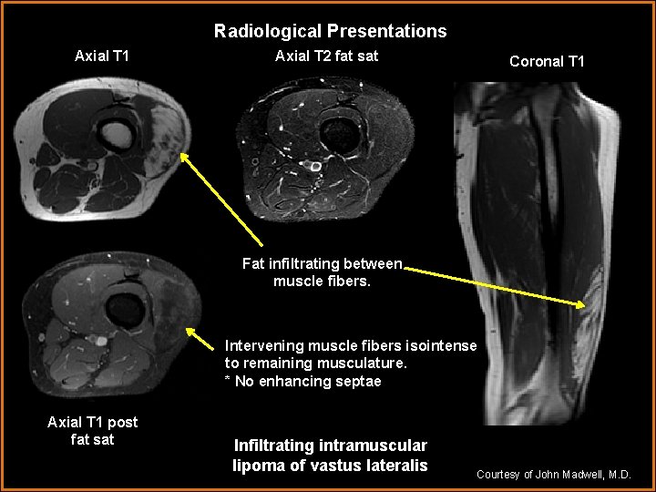 Radiological Presentations Axial T 1 Axial T 2 fat sat Coronal T 1 Fat