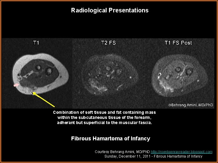 Radiological Presentations Combination of soft tissue and fat containing mass within the subcutaneous tissue