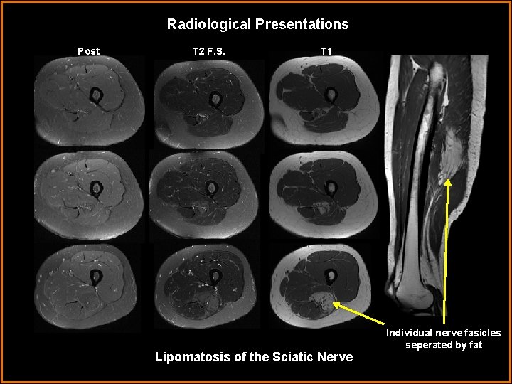 Radiological Presentations Post T 2 F. S. T 1 Lipomatosis of the Sciatic Nerve