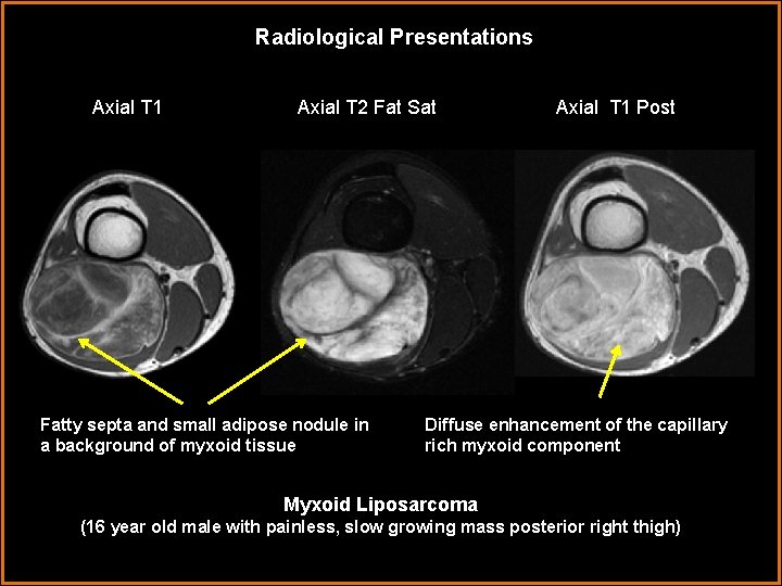 Radiological Presentations Axial T 1 Axial T 2 Fat Sat Fatty septa and small