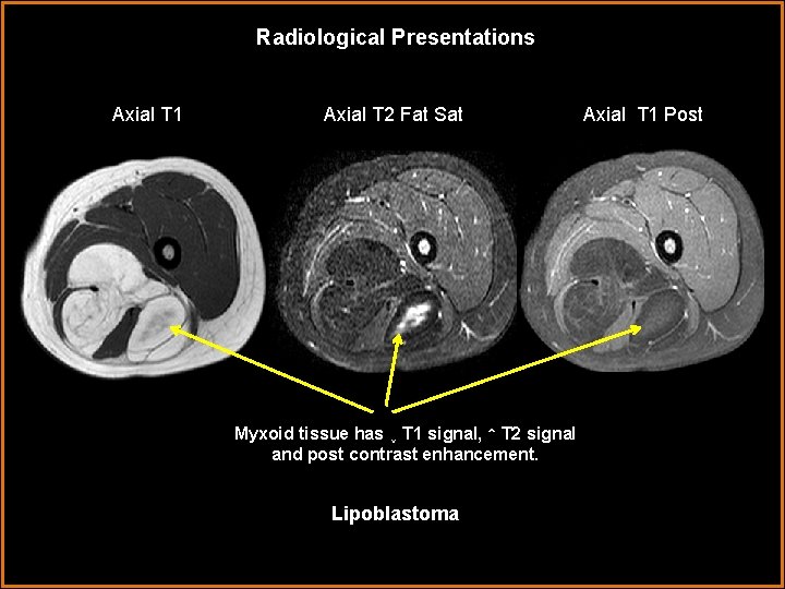 Radiological Presentations Axial T 1 Axial T 2 Fat Sat Myxoid tissue has ↓