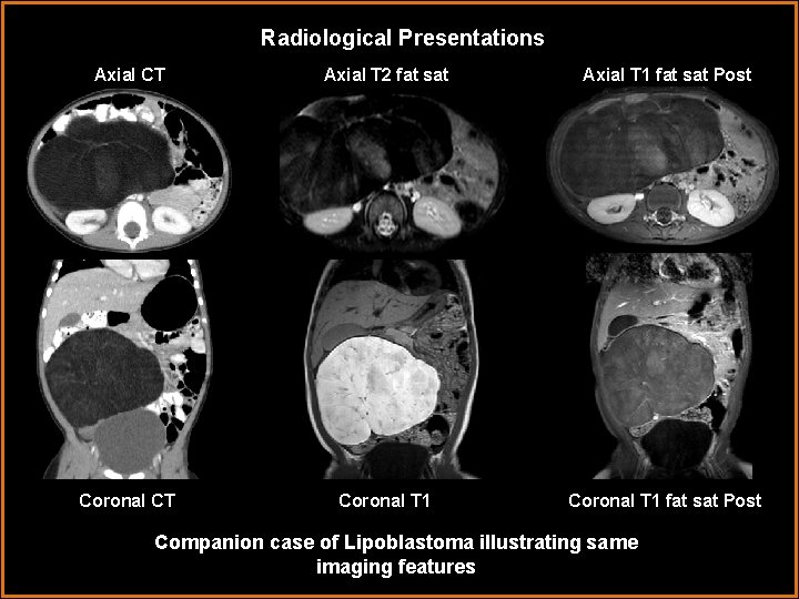 Radiological Presentations Axial CT Axial T 2 fat sat Axial T 1 fat sat