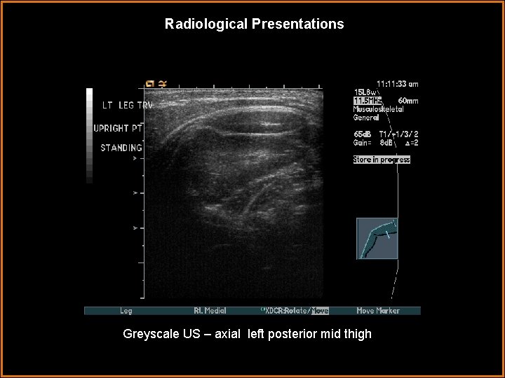 Radiological Presentations Greyscale US – axial left posterior mid thigh 